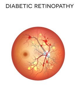 Diabetic Eye Disease in Chicago